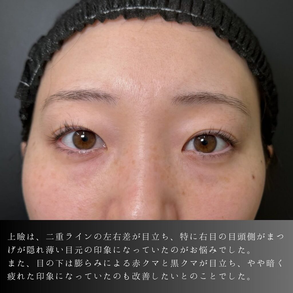 埋没法と裏ハムラ法の用例写真 (5)