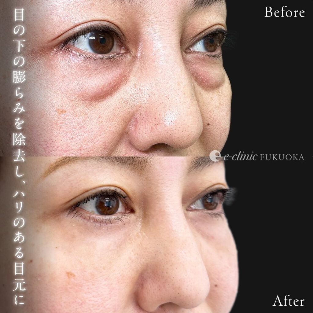 目の下のクマ取りと裏ハムラ法と目の下の脂肪注入の症例写真 (6)