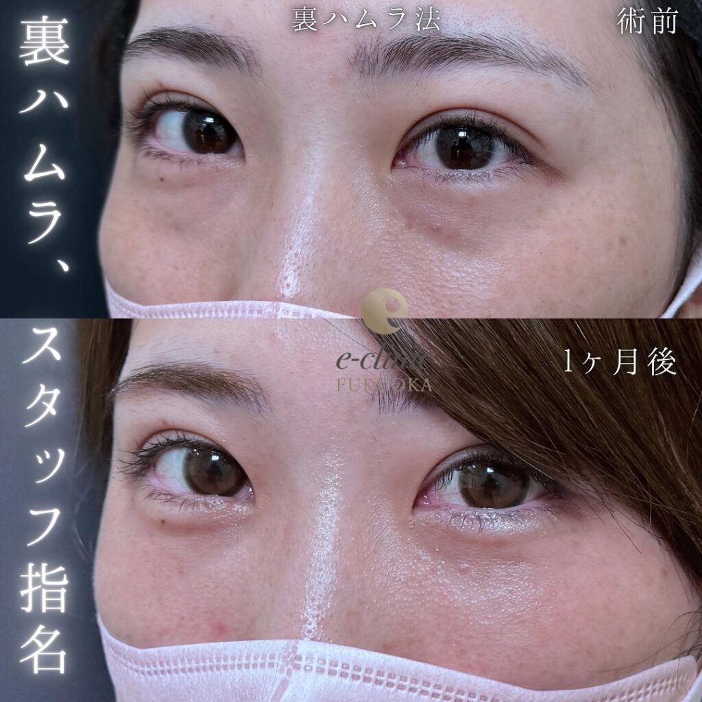 裏ハムラ法の症例写真 (76)