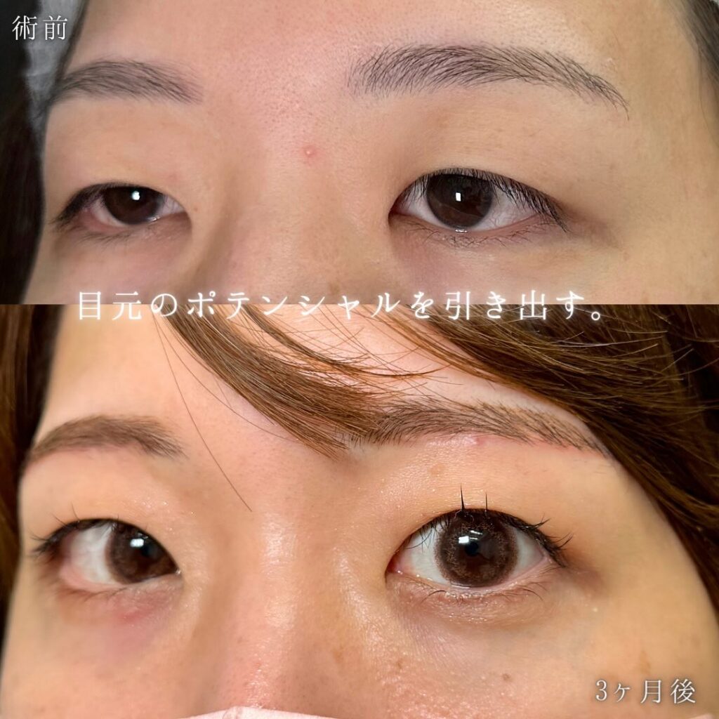 眉下切開の症例写真 (2)