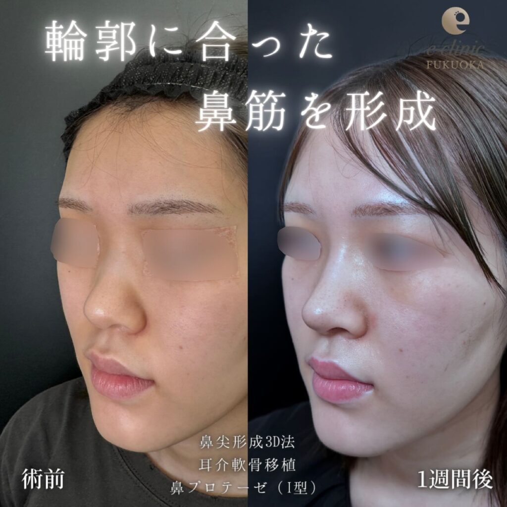 鼻尖形成と耳介軟骨移植とプロテーゼの症例写真 (2)