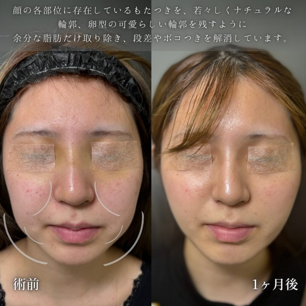 小顔脂肪吸引とバッカルファットとジョールファットとメーラーファットと糸リフトの症例写真 (4)