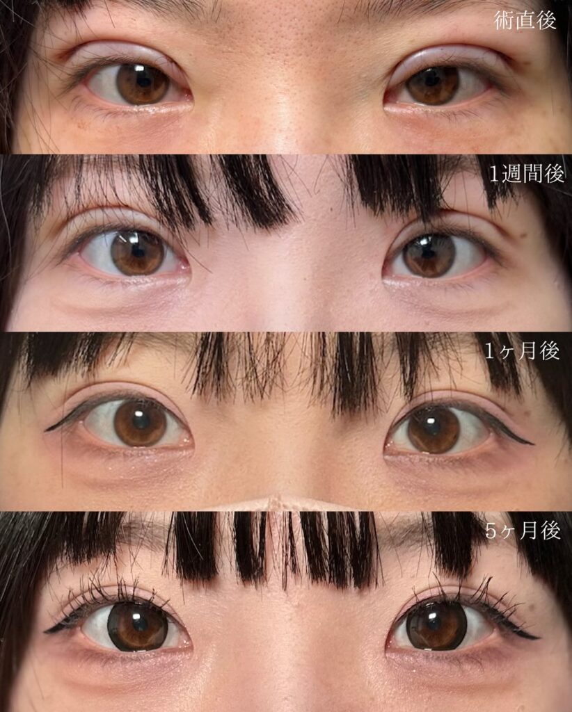 全切開の症例写真 (3)