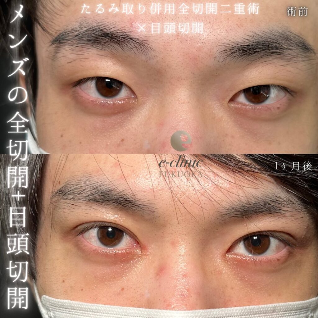 たるみ取り併用全切開と目頭切開の症例写真 (1)