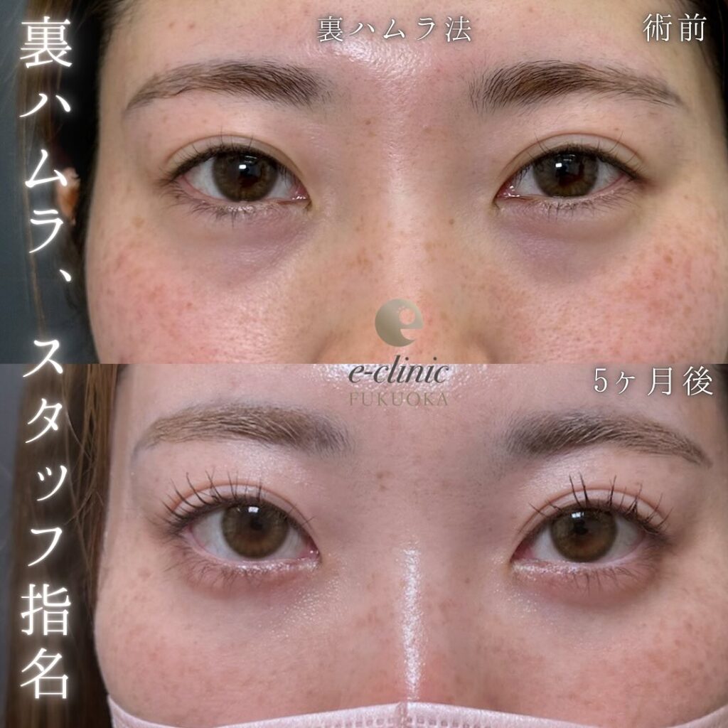 裏ハムラ法の症例写真 (78)