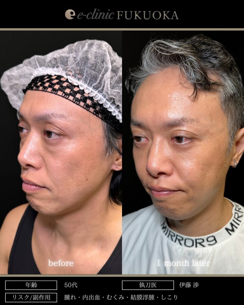 脱脂と脂肪注入の症例写真 (15)