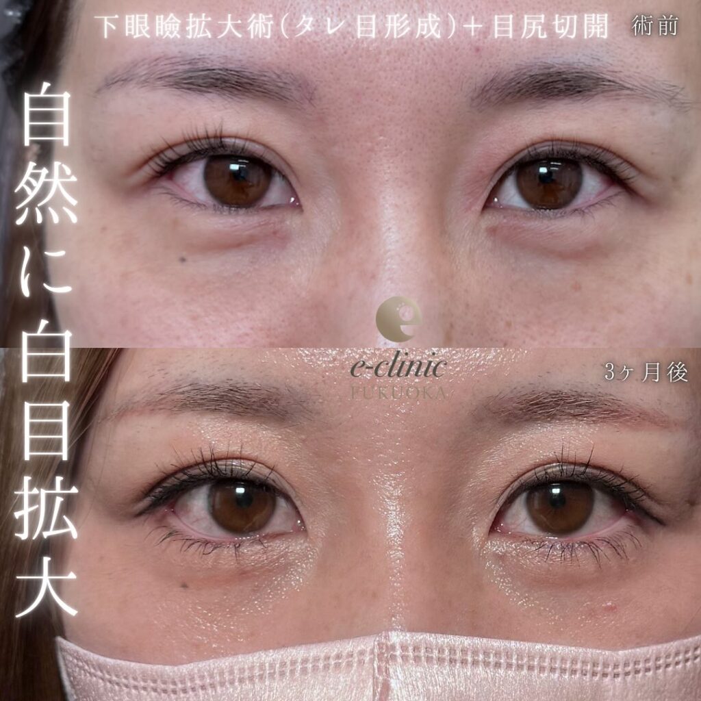 タレ目形成と目尻切開の症例写真 (5)