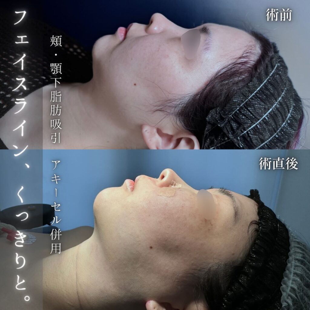 頬と顎下の脂肪吸引の症例写真