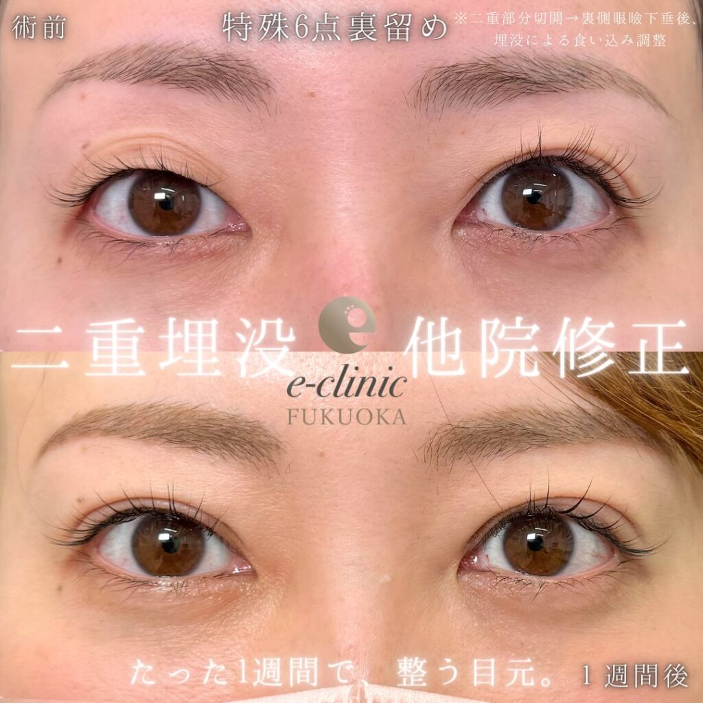 埋没法と他院修正の症例写真 (1)