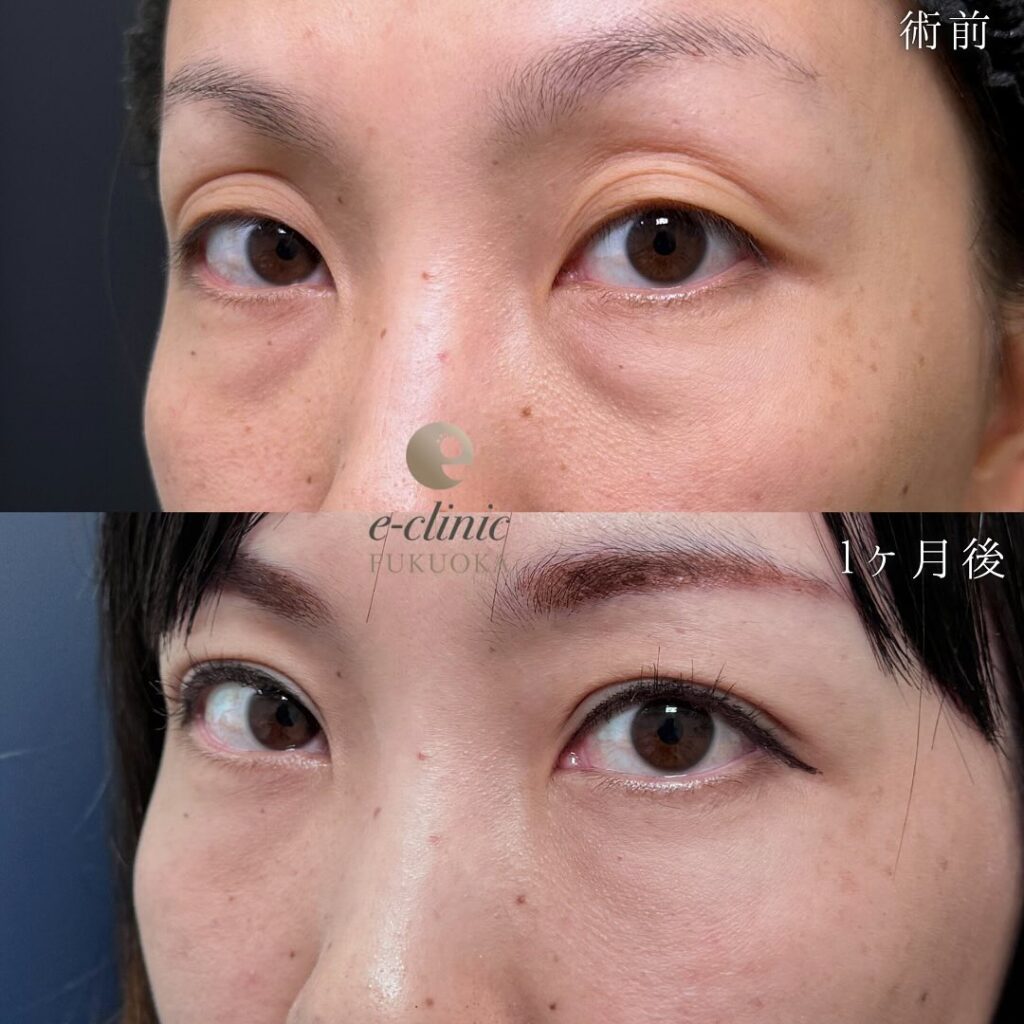 自然癒着法と裏ハムラ法の症例写真 (3)