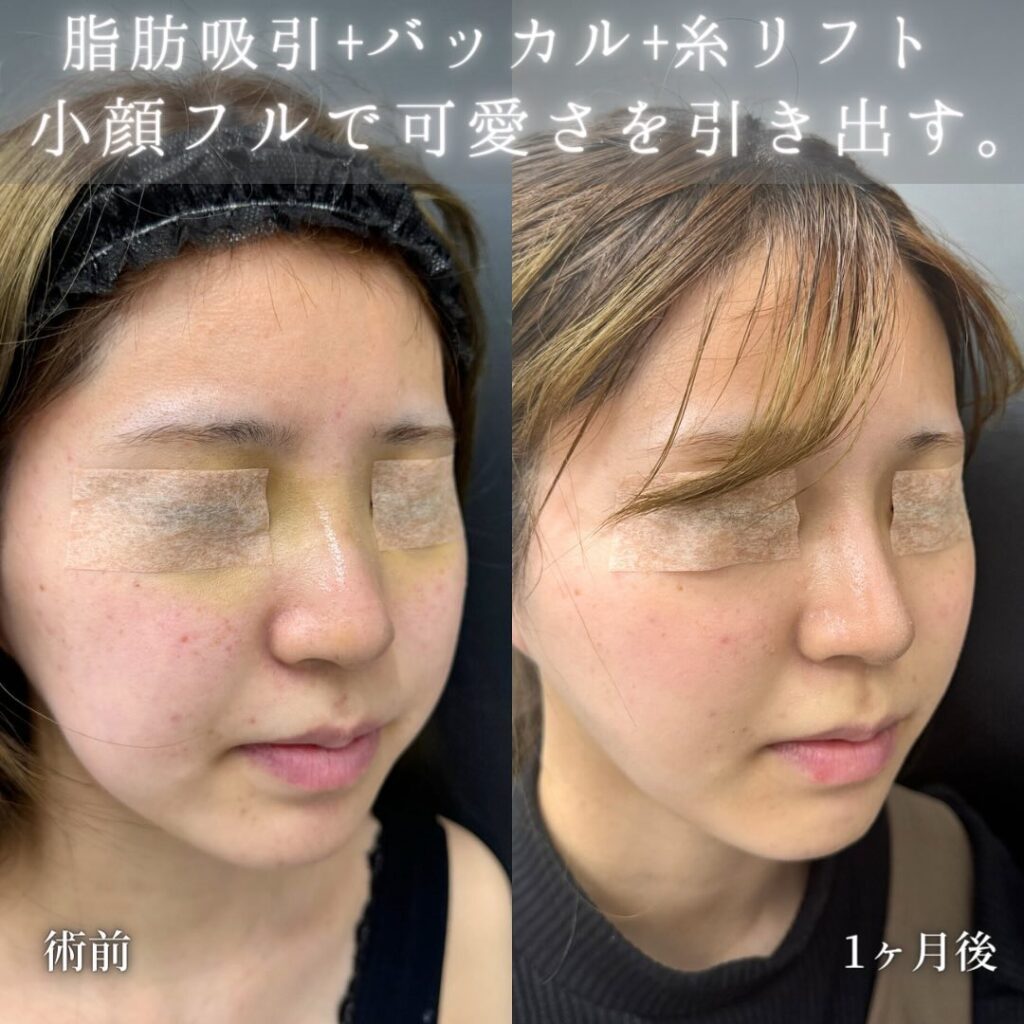 小顔脂肪吸引とバッカルファットとジョールファットとメーラーファットと糸リフトの症例写真 (2)