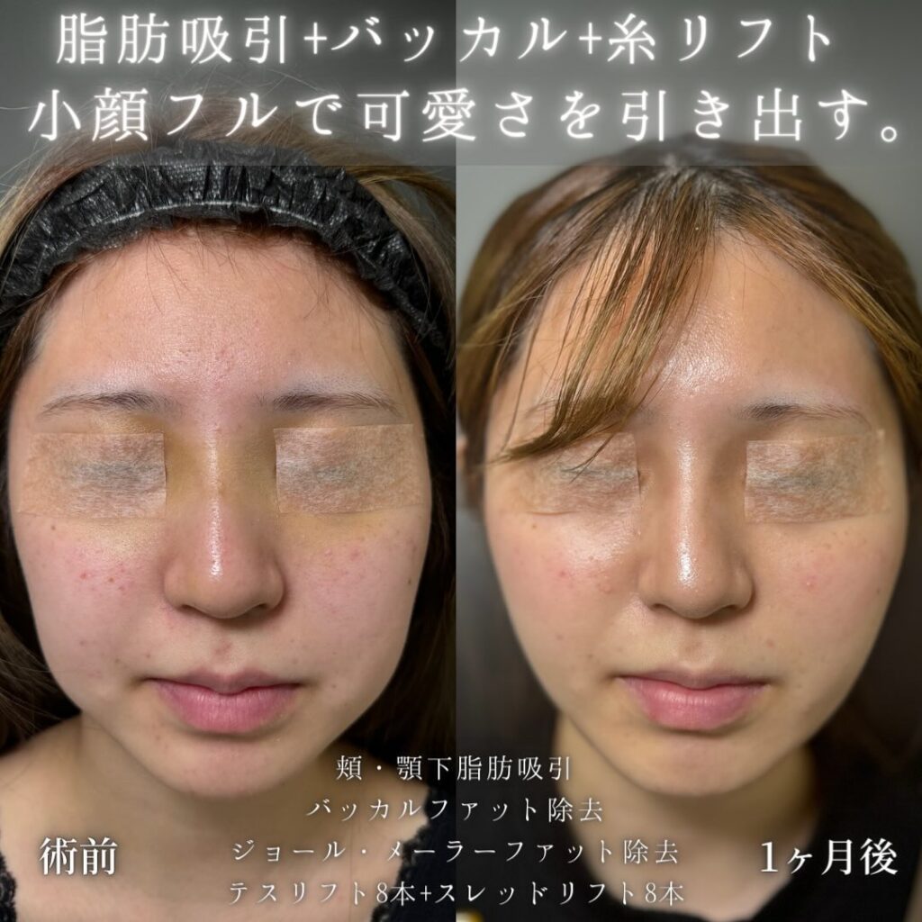 小顔脂肪吸引とバッカルファットとジョールファットとメーラーファットと糸リフトの症例写真 (1)