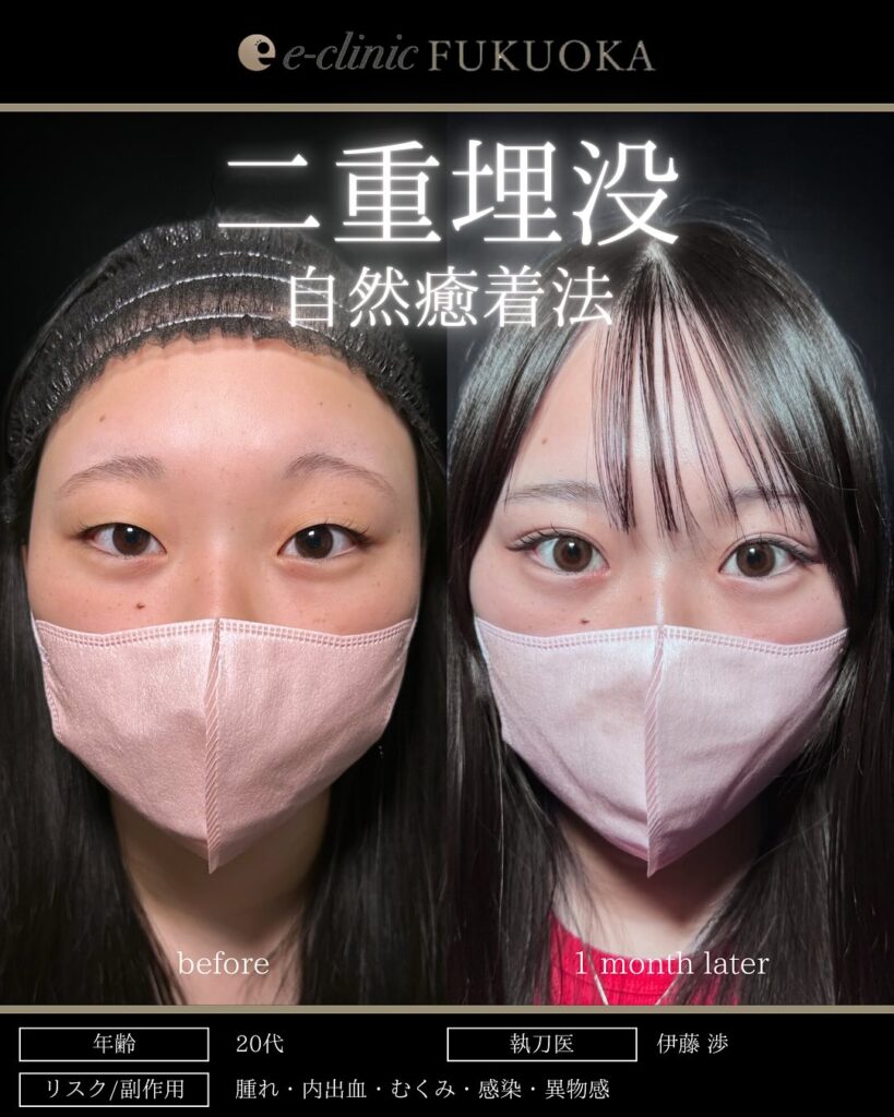 自然癒着法の症例写真 (13)