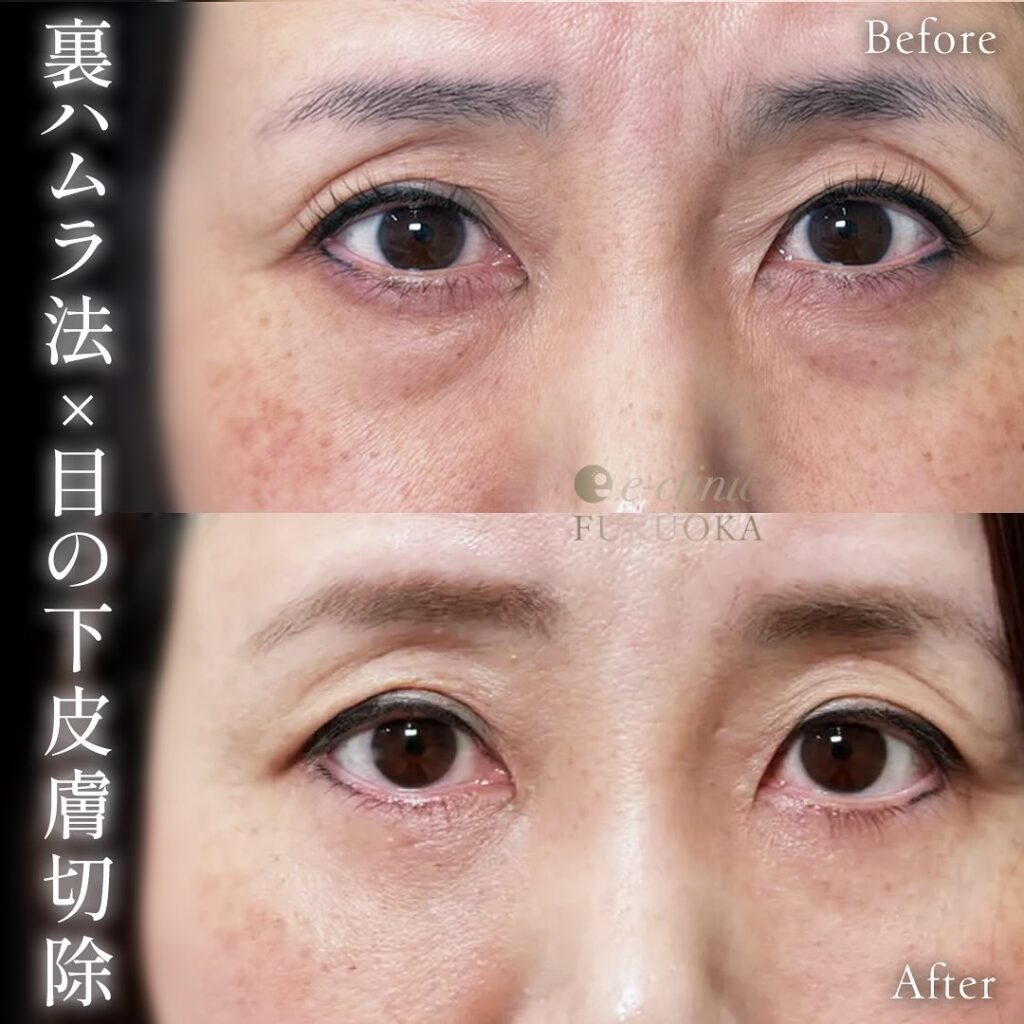 裏ハムラ法と目の下の脂肪注入と額とこめかみの脂肪注入の症例写真 (6)