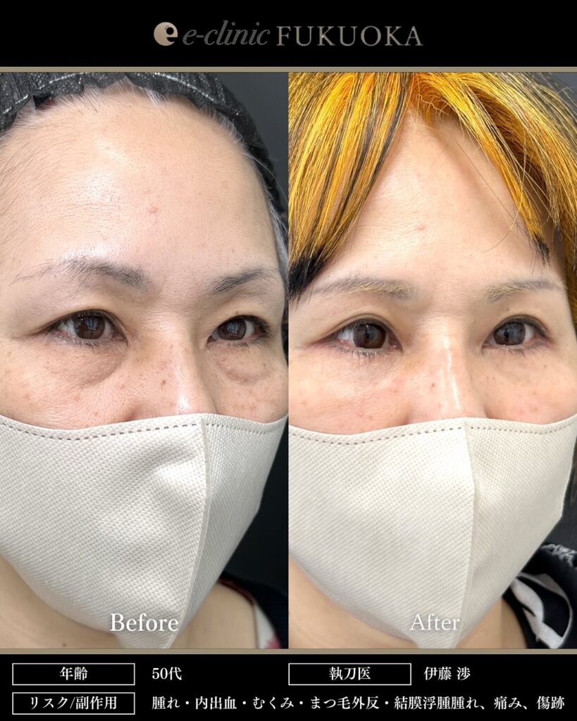 裏ハムラ法と眉下切開の症例写真 (2)