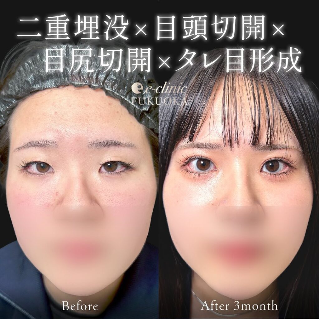 目元拡大の症例写真 (1)