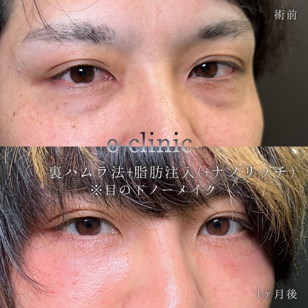 裏ハムラ法と脂肪注入の症例写真 (3)