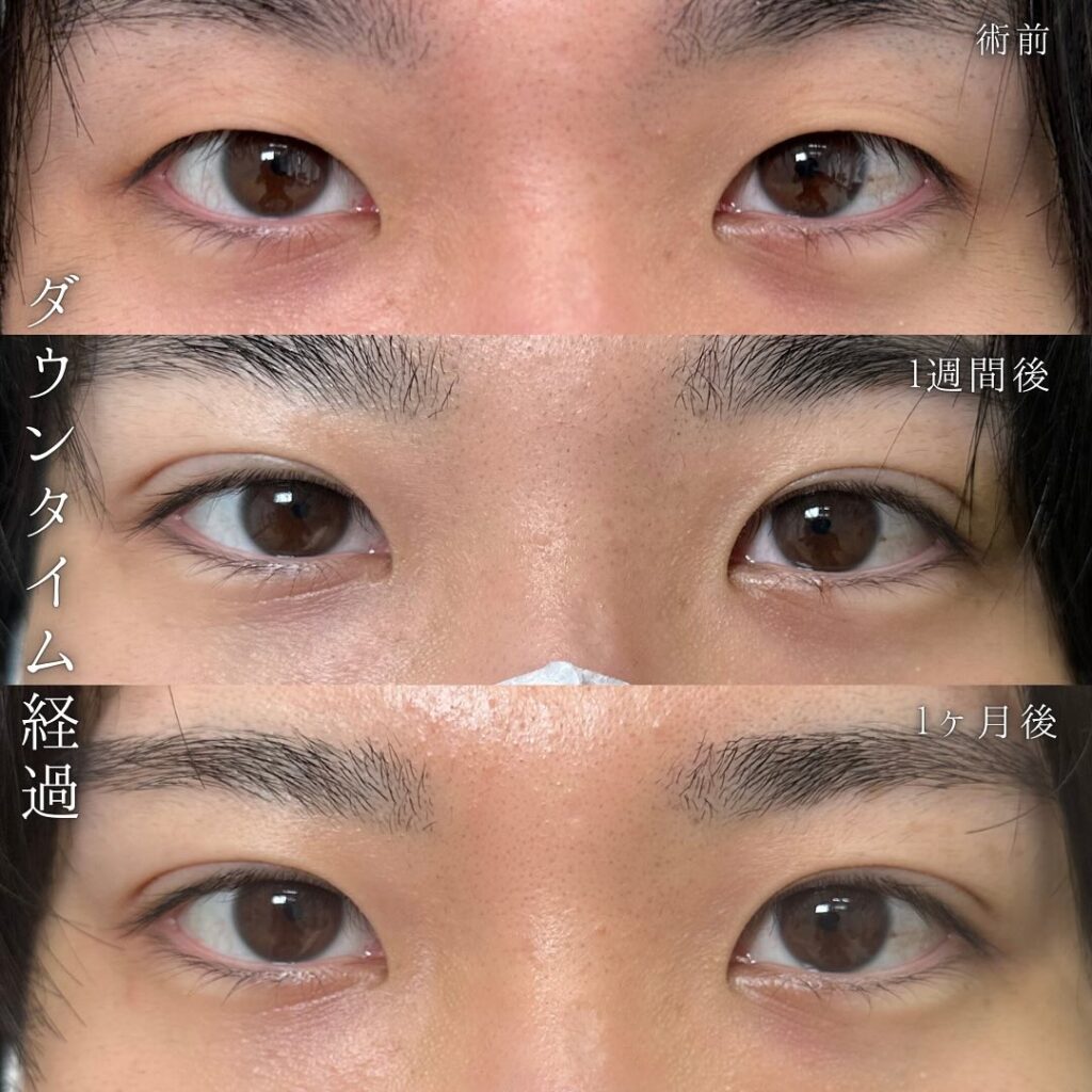 自然癒着法の症例写真 (12)