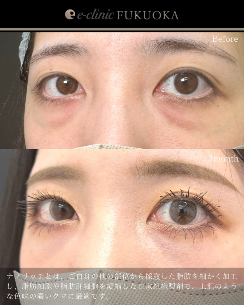 裏ハムラ法とナノリッチの症例写真 (17)