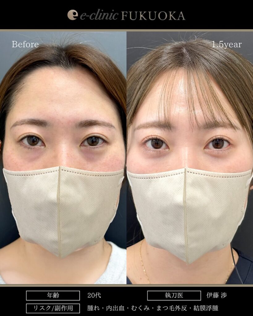 裏ハムラ法の症例写真 (95)