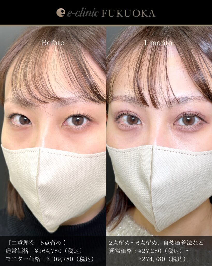 埋没法の症例写真 (15)