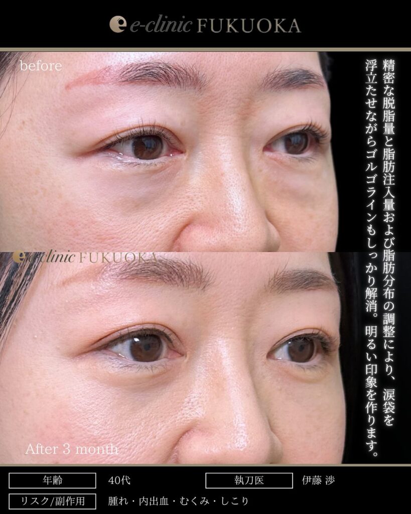 他院のクマ取り修正と脂肪注入と脱脂の症例写真 (3)