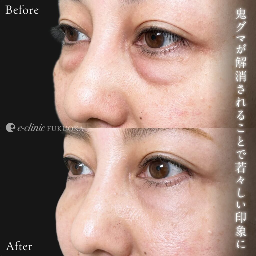 目の下のクマ取りと裏ハムラ法と目の下の脂肪注入の症例写真 (5)