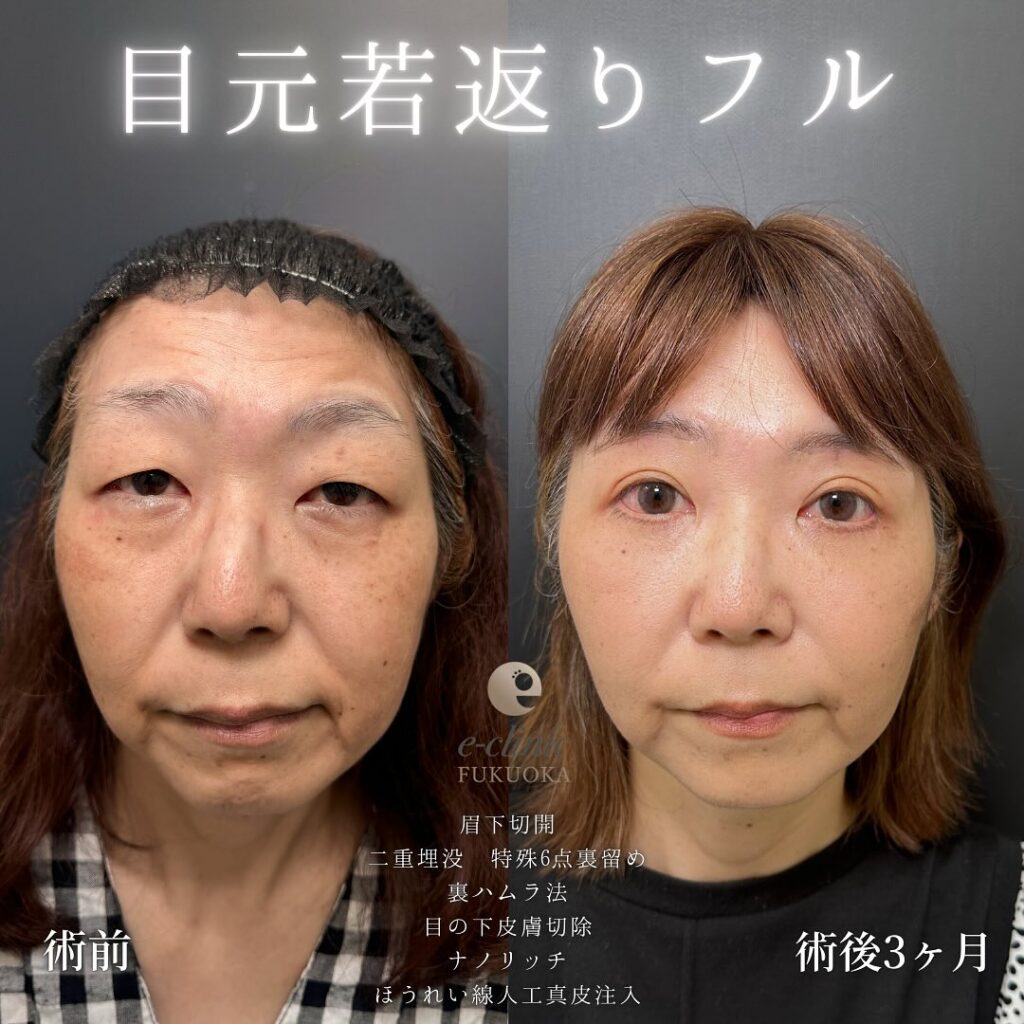 眉下切開と埋没法と裏ハムラ法と目の下の脂肪注入とほうれい線の人工真皮の症例写真 (1)
