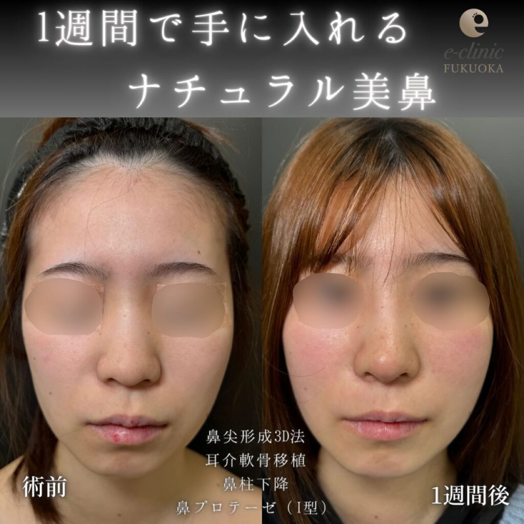 鼻尖形成と軟骨移植とプロテーゼと鼻柱下降の症例写真 (2)