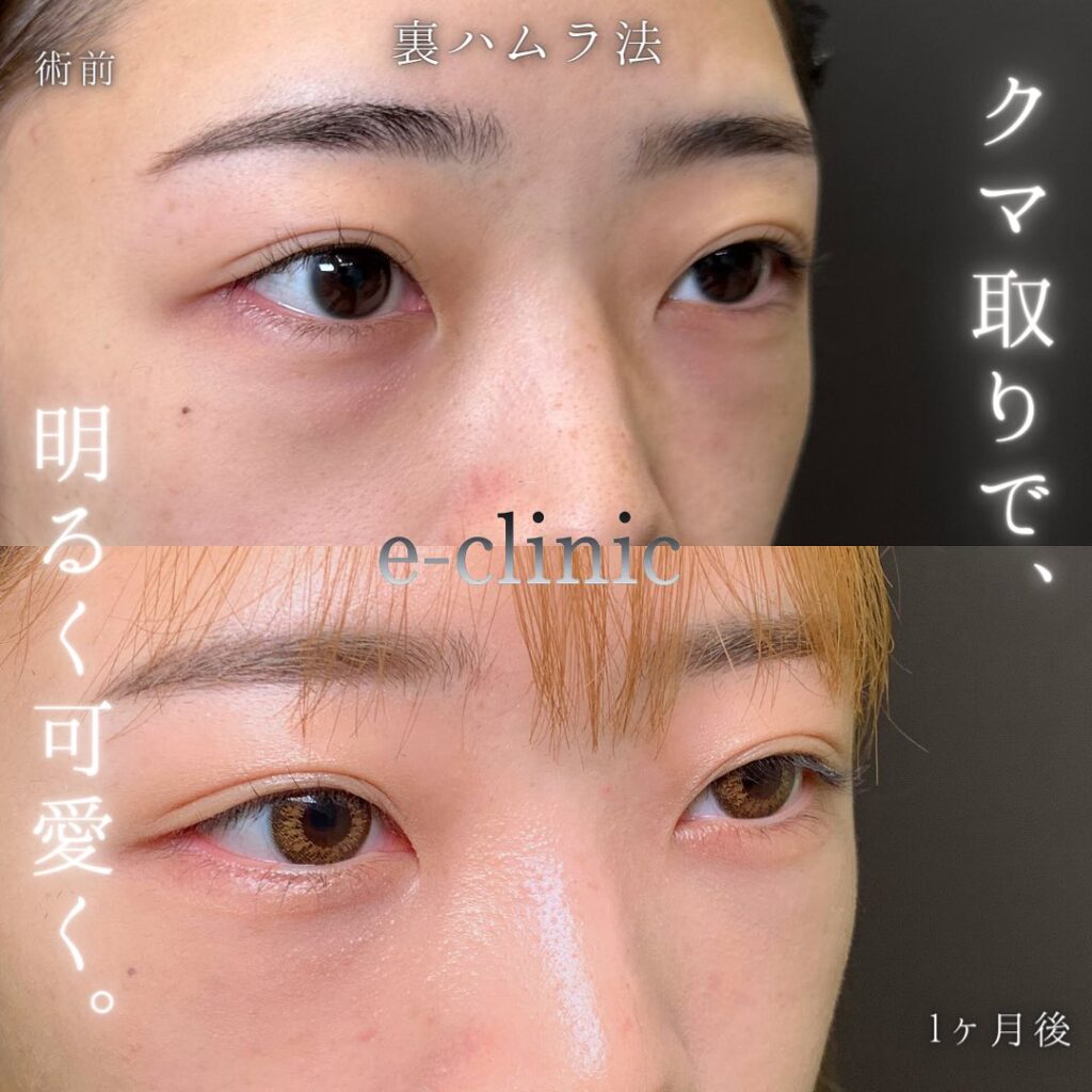 裏ハムラ法の症例写真 (46)