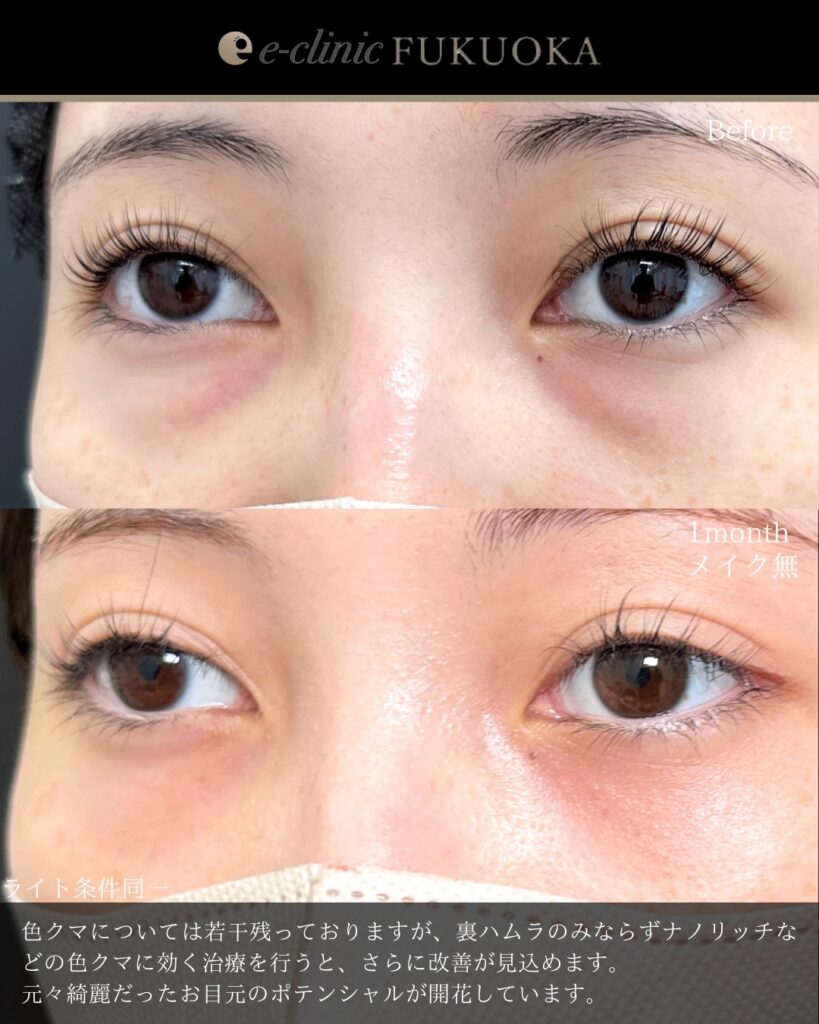 裏ハムラ法の症例写真 (104)