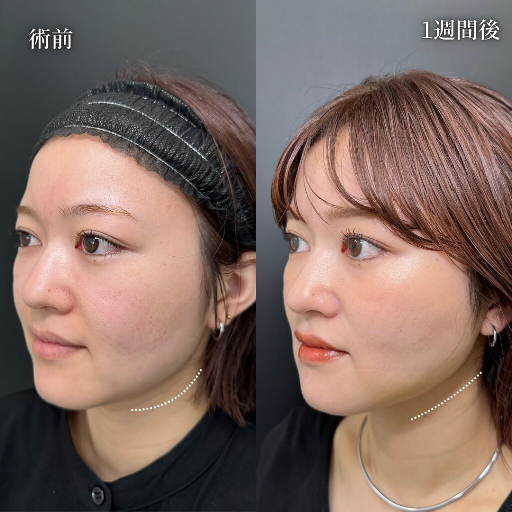 頬の脂肪吸引とジュールファットと糸リフトの症例写真 (4)