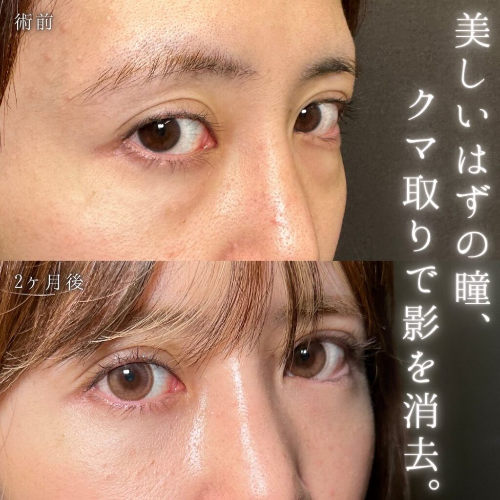 裏ハムラ法の症例写真 (29)