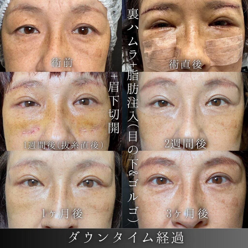裏ハムラ法と脂肪注入と眉下切開の症例写真