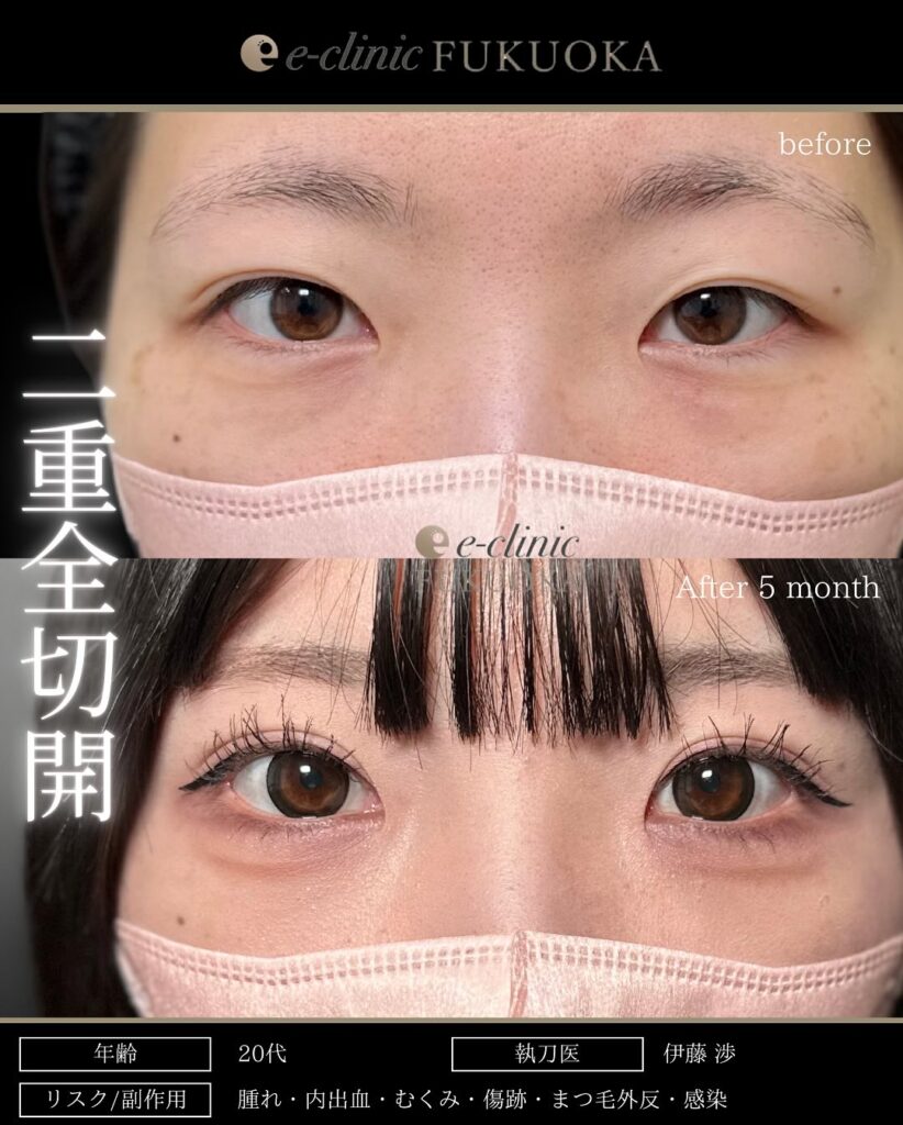 全切開の症例写真 (1)