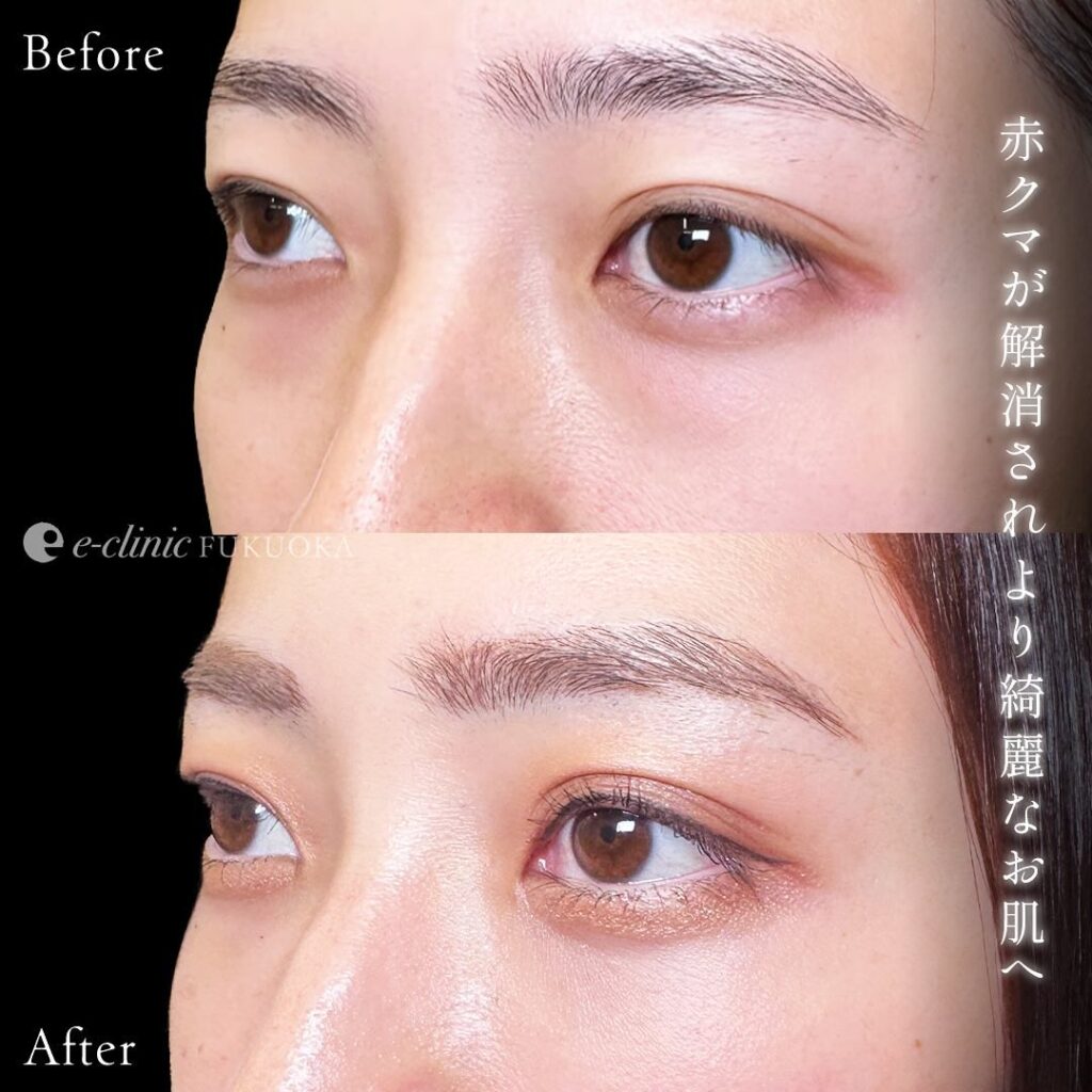 裏ハムラ法の症例写真 (86)