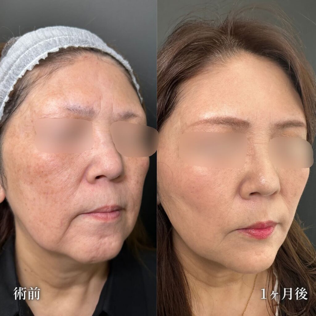 ハイブリッドフェイスリフトの症例写真 (2)