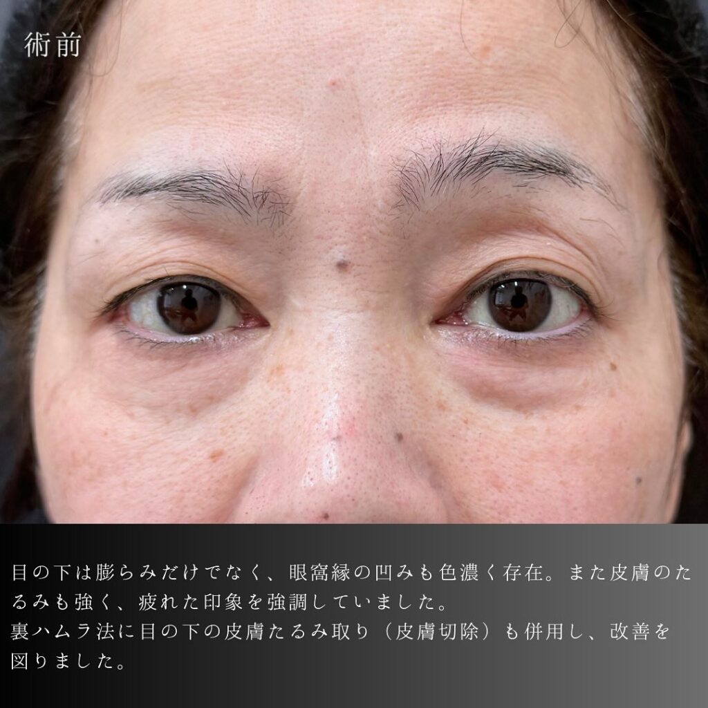 裏ハムラ法の症例写真 (71)