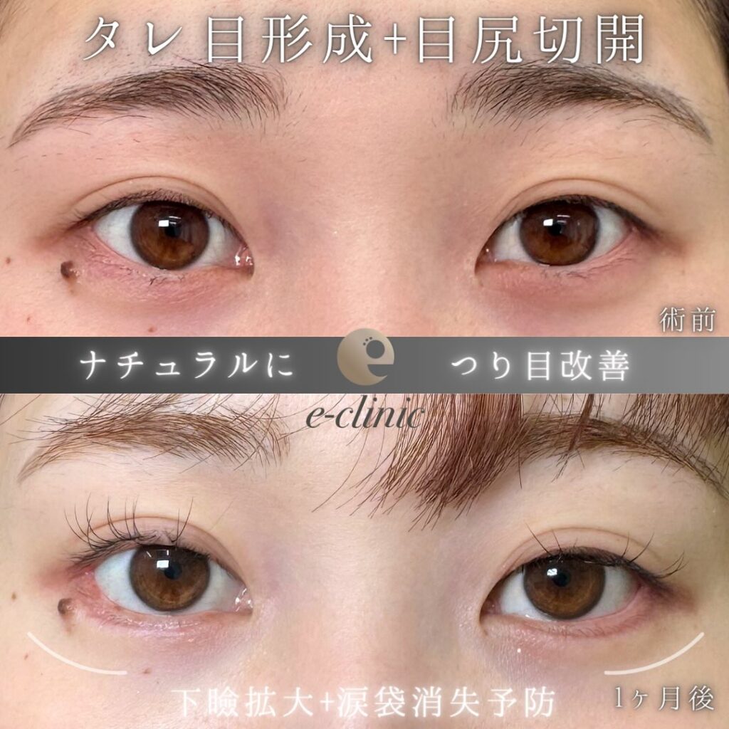 タレ目形成と目尻切開の症例写真 (1)