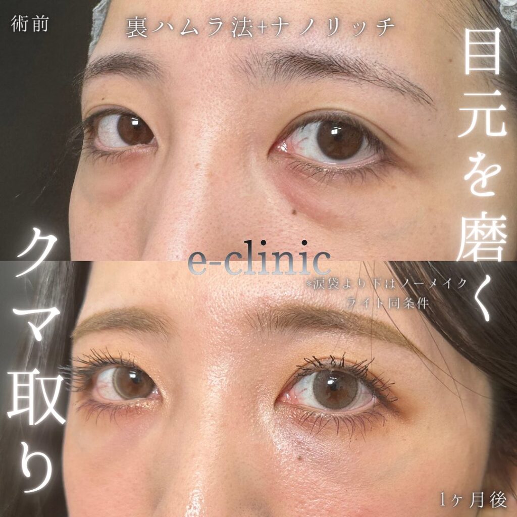 裏ハムラ法と脂肪注入の症例写真 (10)