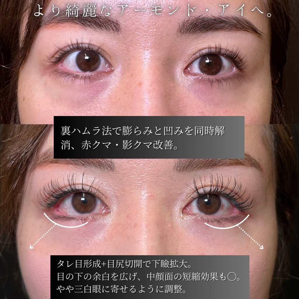 目尻切開とタレ目形成と裏ハムラ法の症例写真 (4)