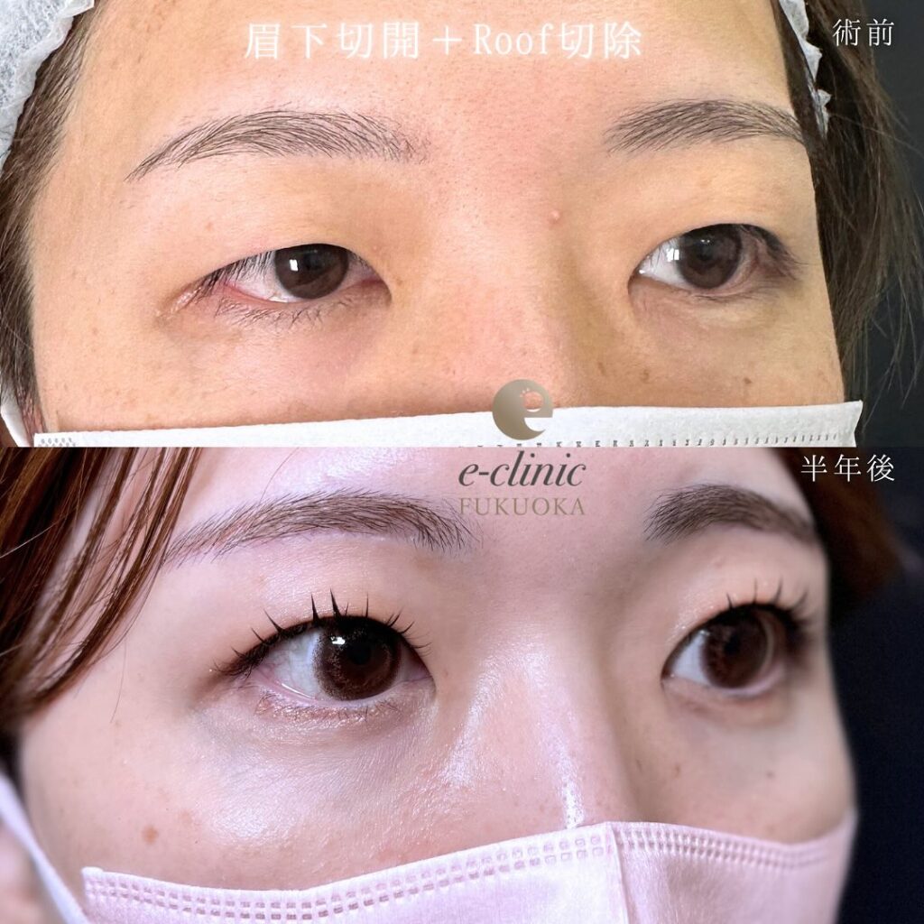 眉下切開の症例写真 (6)