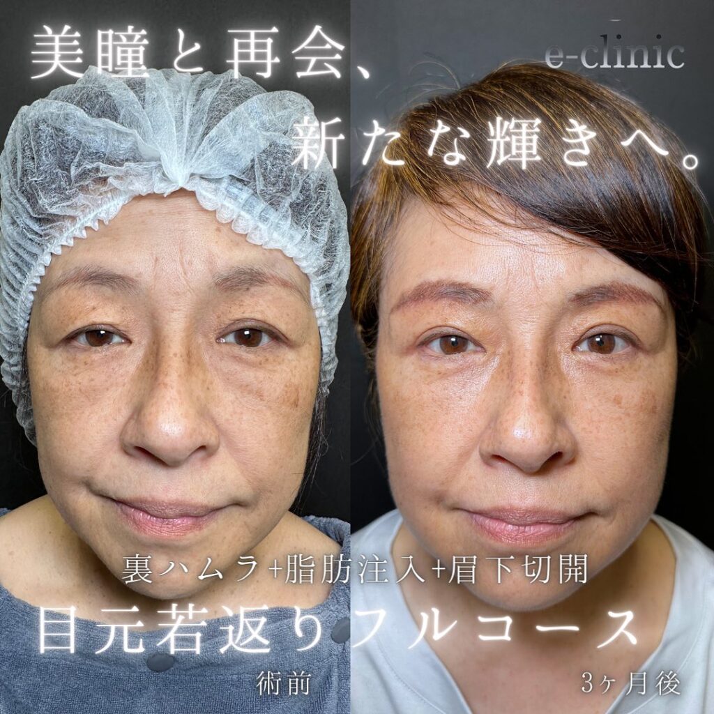 裏ハムラ法と脂肪注入と眉下切開の症例写真 (1)