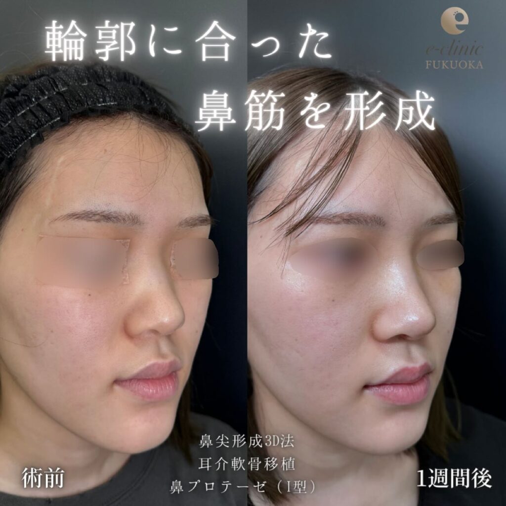 鼻尖形成と耳介軟骨移植とプロテーゼの症例写真 (3)