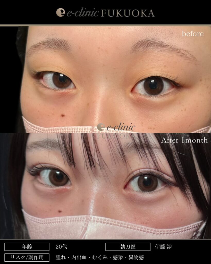 自然癒着法の症例写真 (15)