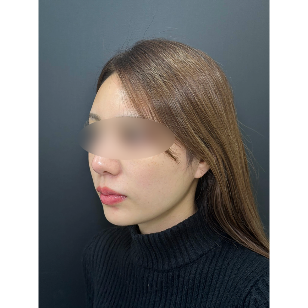 eクリニック福岡院の小顔脂肪吸引＋糸リフトの症例術前写真（名医の伊藤渉医師が執刀）・頬・顎下・ジョールファット脂肪吸引
・バッカルファット除去
・糸リフト（スレッドリフト8本）