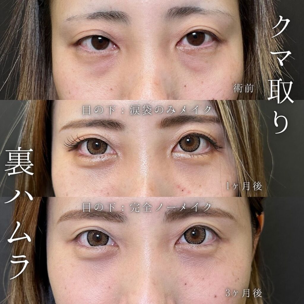 裏ハムラ法の症例写真 (44)