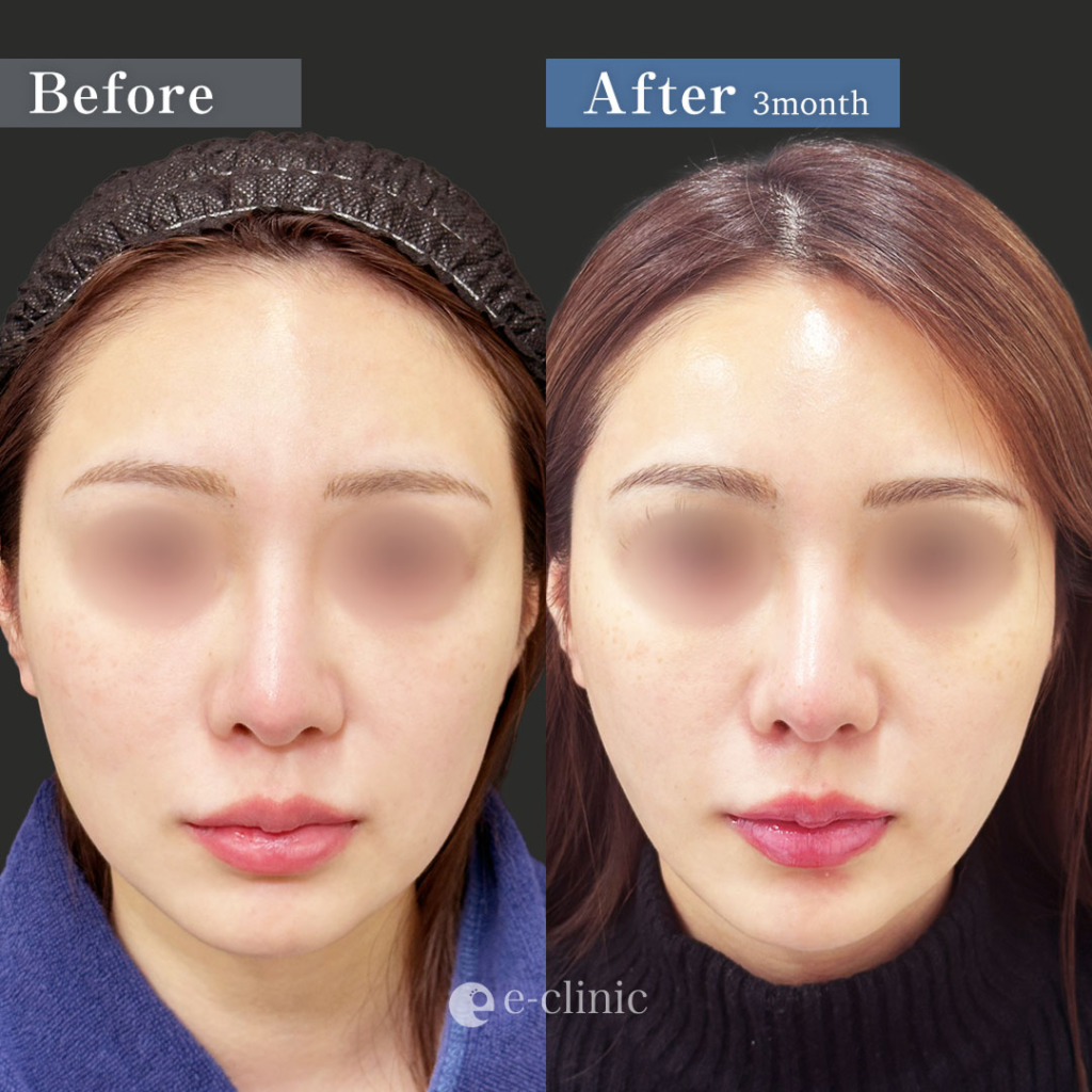 ・頬・顎下・ジョールファット脂肪吸引 ・バッカルファット除去 ・糸リフト（スレッドリフト8本）