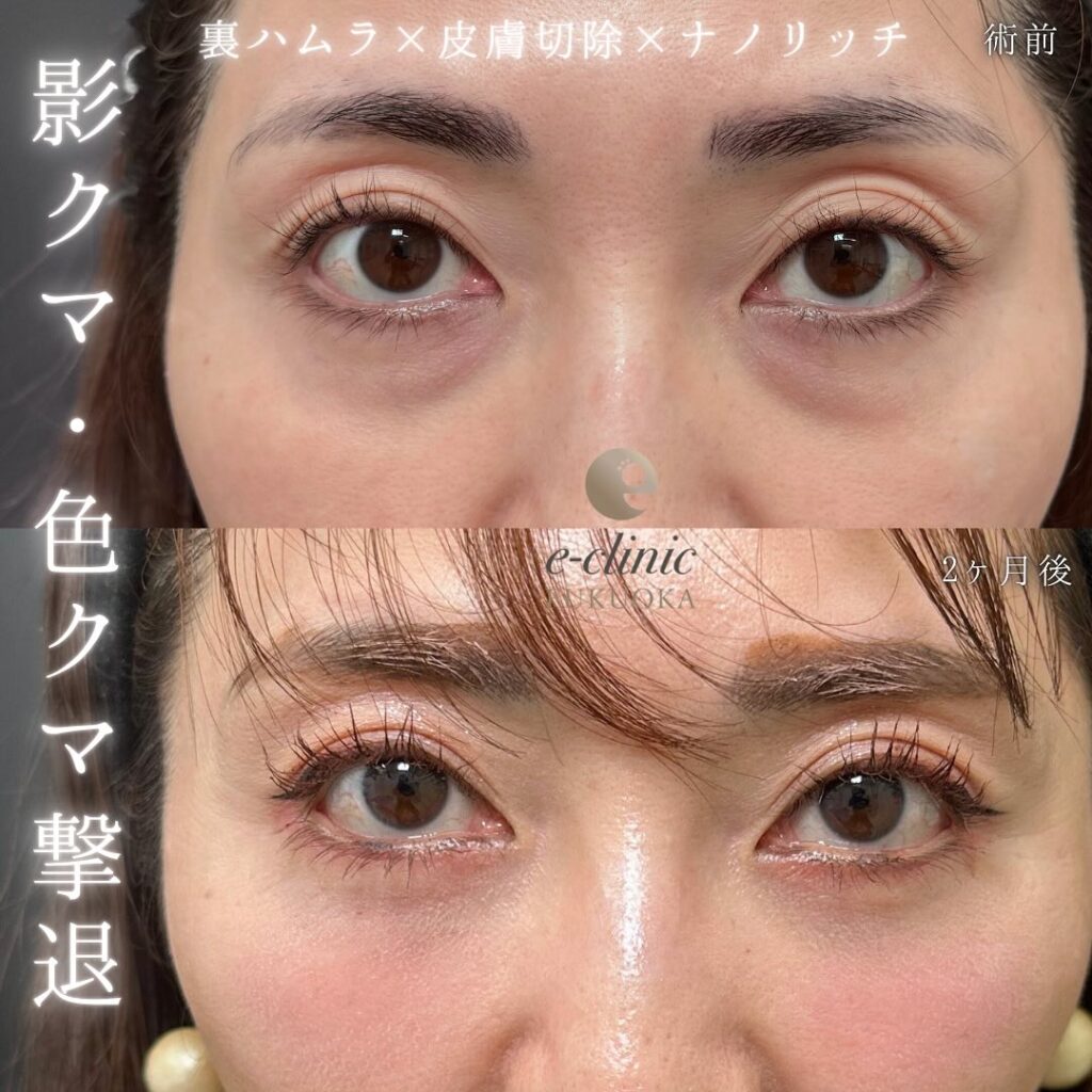 裏ハムラ法と目の下の脂肪注入の症例写真 (1)