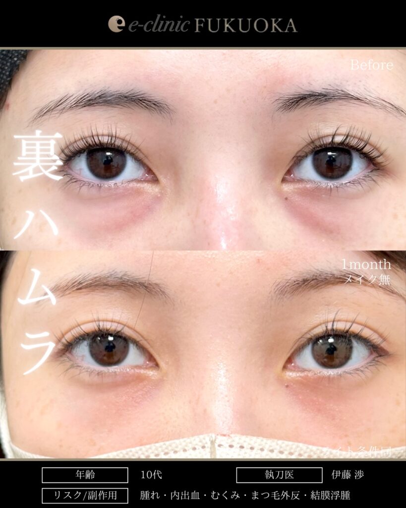 裏ハムラ法の症例写真 (102)